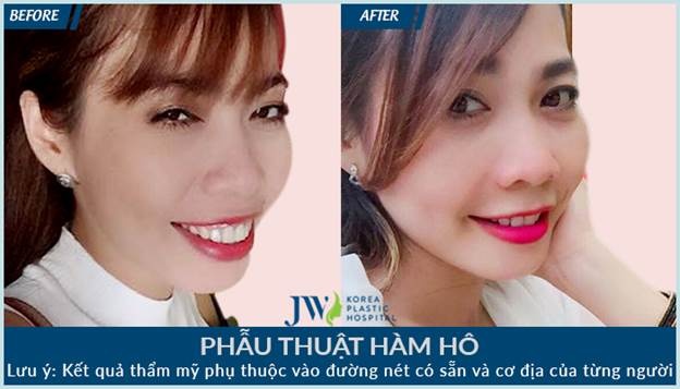 Bệnh viện Thẩm mỹ JW Hàn Quốc ảnh 3 Benh vien Tham my JW Han Quoc anh 3
