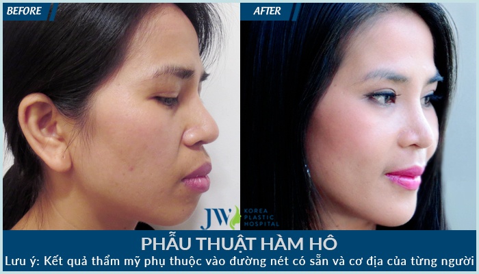 Bệnh viện Thẩm mỹ JW Hàn Quốc ảnh 6 Benh vien Tham my JW Han Quoc anh 6