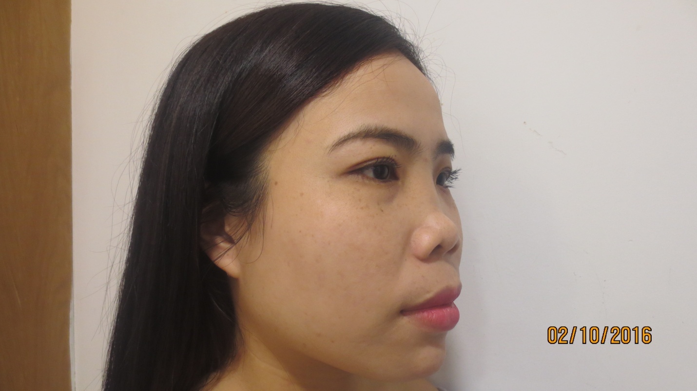 Bệnh viện thẩm mỹ JW Hàn Quốc,  nâng mũi S-line ảnh 2 Benh vien tham my JW Han Quoc,  nang mui S-line anh 2