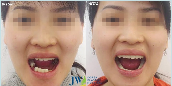 Bệnh viện thẩm mỹ JW Hàn Quốc ảnh 3 Benh vien tham my JW Han Quoc anh 3