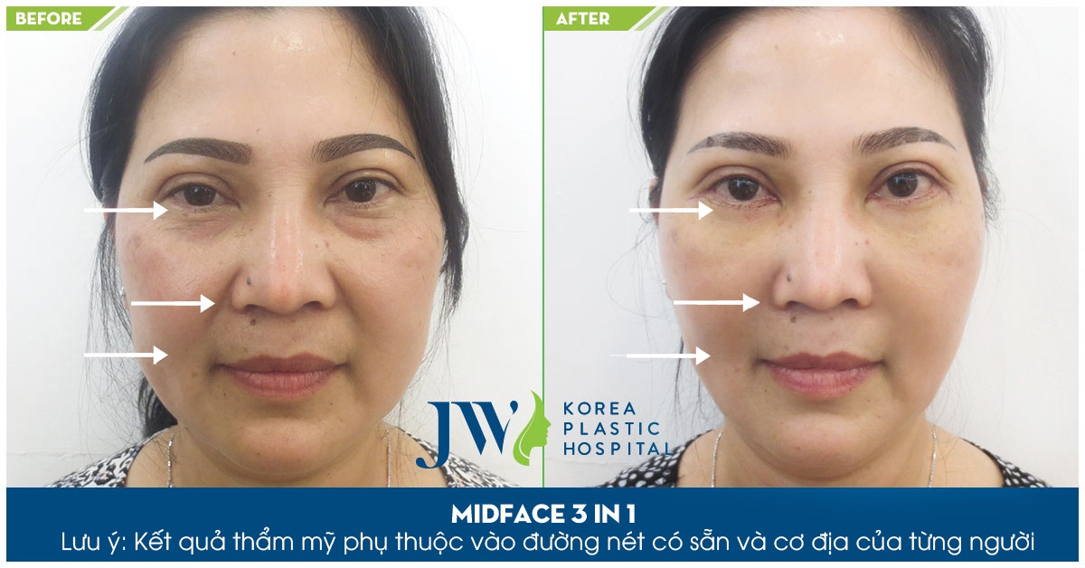 Bệnh viện thẩm mỹ JW Hàn Quốc chi nhánh Việt Nam ảnh 5 Benh vien tham my JW Han Quoc chi nhanh Viet Nam anh 5