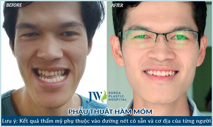 Benh vien tham my JW Han Quoc chi nhanh Viet Nam anh 5