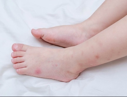 Chua viem da di ung cho tre bang thao duoc hinh anh