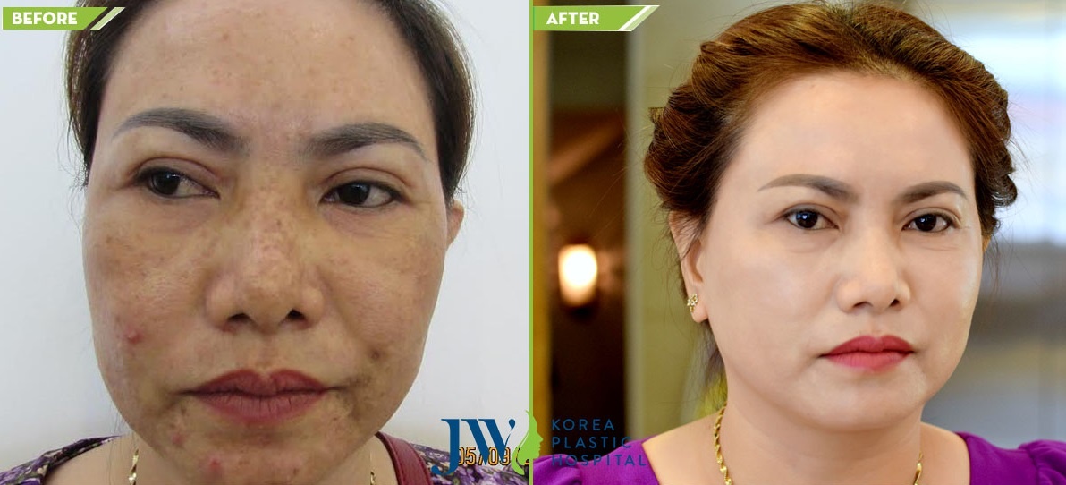 Bệnh viện thẩm mỹ JW Hàn Quốc  ảnh 3 Benh vien tham my JW Han Quoc anh 3