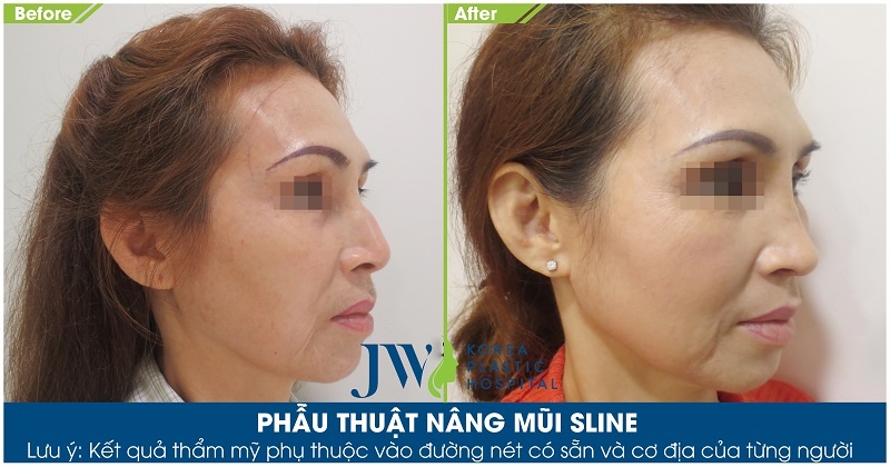 Benh vien tham my JW Han Quoc anh 3