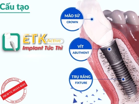 Rut ngan thoi gian trong rang gia bang Implant ETK Active moi hinh anh