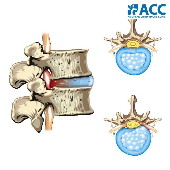 nhận biết sớm dấu hiệu thoát vị đĩa đệm ảnh 1 nhan biet som dau hieu thoat vi dia dem anh 1