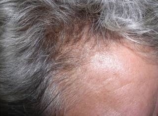 Nghien cuu moi ve dieu tri vay nen da dau hinh anh