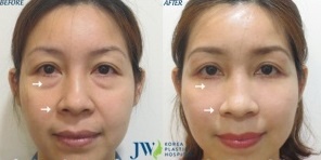 Bệnh viện thẩm mỹ JW Hàn Quốc ảnh 2 Benh vien tham my JW Han Quoc anh 2
