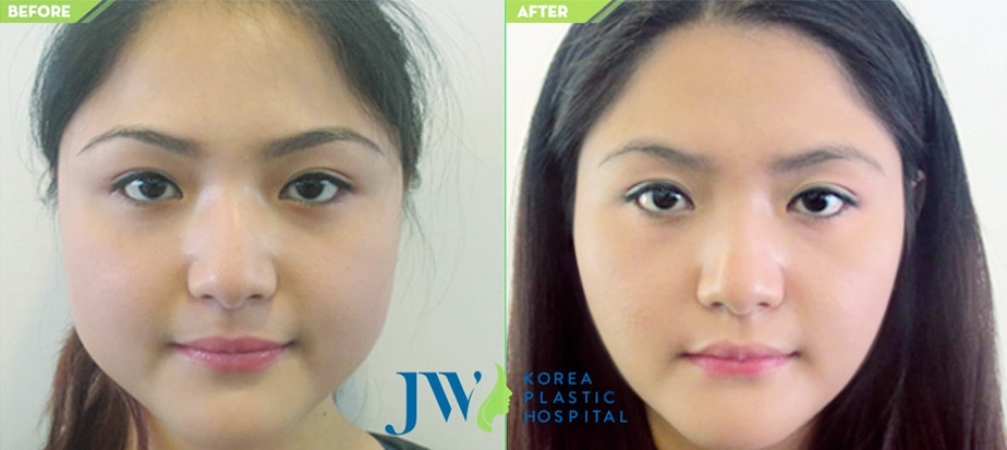 Bệnh viện thẩm mỹ JW Hàn Quốc ảnh 3 Benh vien tham my JW Han Quoc anh 3