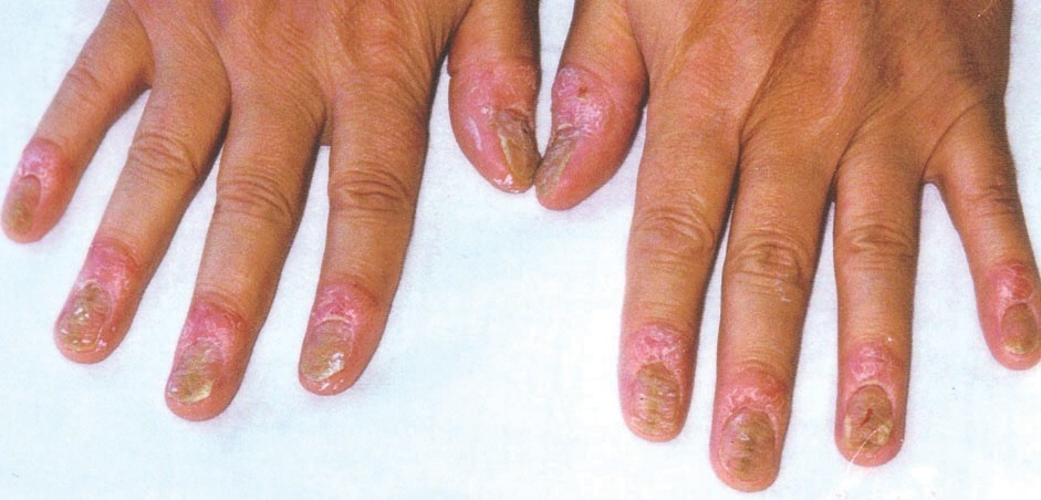 Nghien cuu moi trong dieu tri benh vay nen mong hinh anh