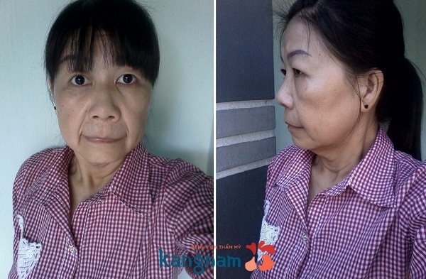 tại Bệnh viện Thẩm mỹ Kangnam  ảnh 1 tai Benh vien Tham my Kangnam anh 1