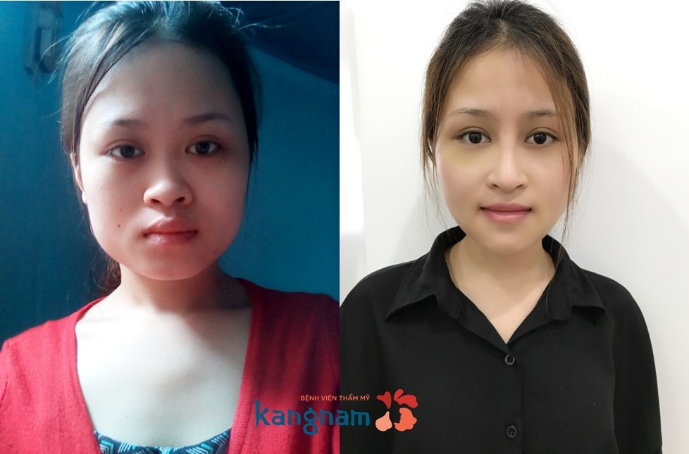 benh vien tham my Kangnam anh 4