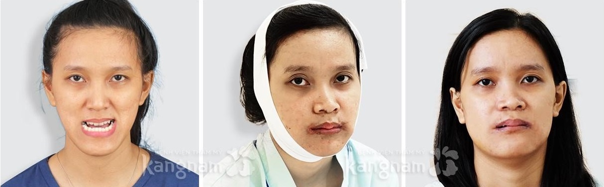 Bệnh viện Thẩm mỹ Kangnam ảnh 5 Benh vien Tham my Kangnam anh 5