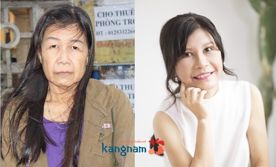Bệnh viện thẩm mỹ Kangnam ảnh 2 Benh vien tham my Kangnam anh 2