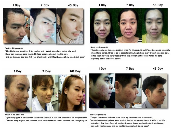 gel trị mụn Acnoc ảnh 3 gel tri mun Acnoc anh 3