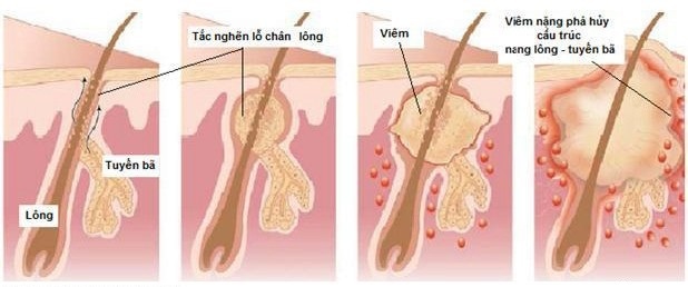 trị mụn Acnes ảnh 3 tri mun Acnes anh 3