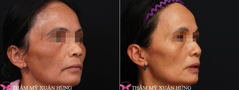 thẩm mỹ viện Xuân Hùng ảnh 4 tham my vien Xuan Hung anh 4