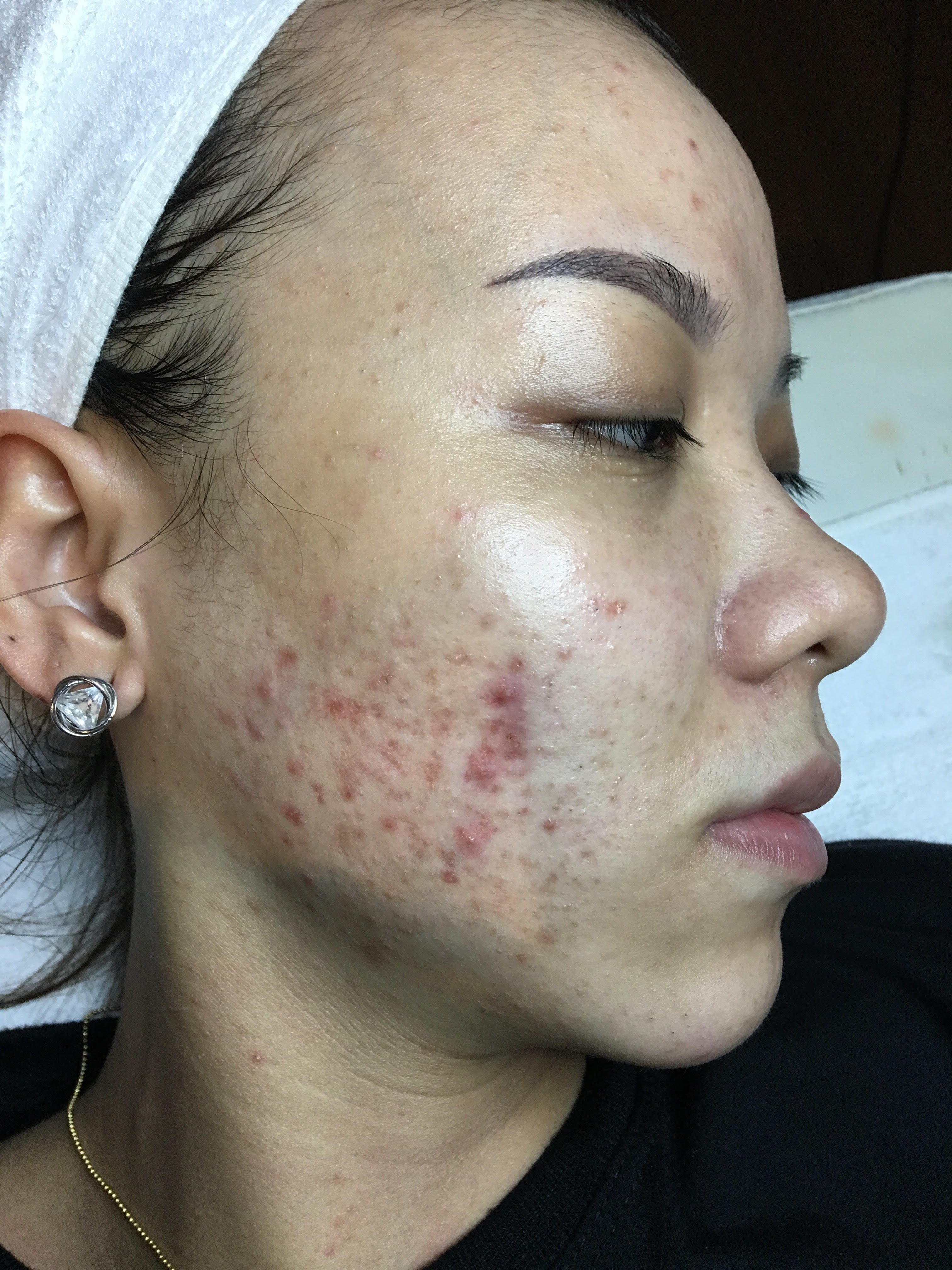 phuong phap tai tao da Ultranano tao song anh 1