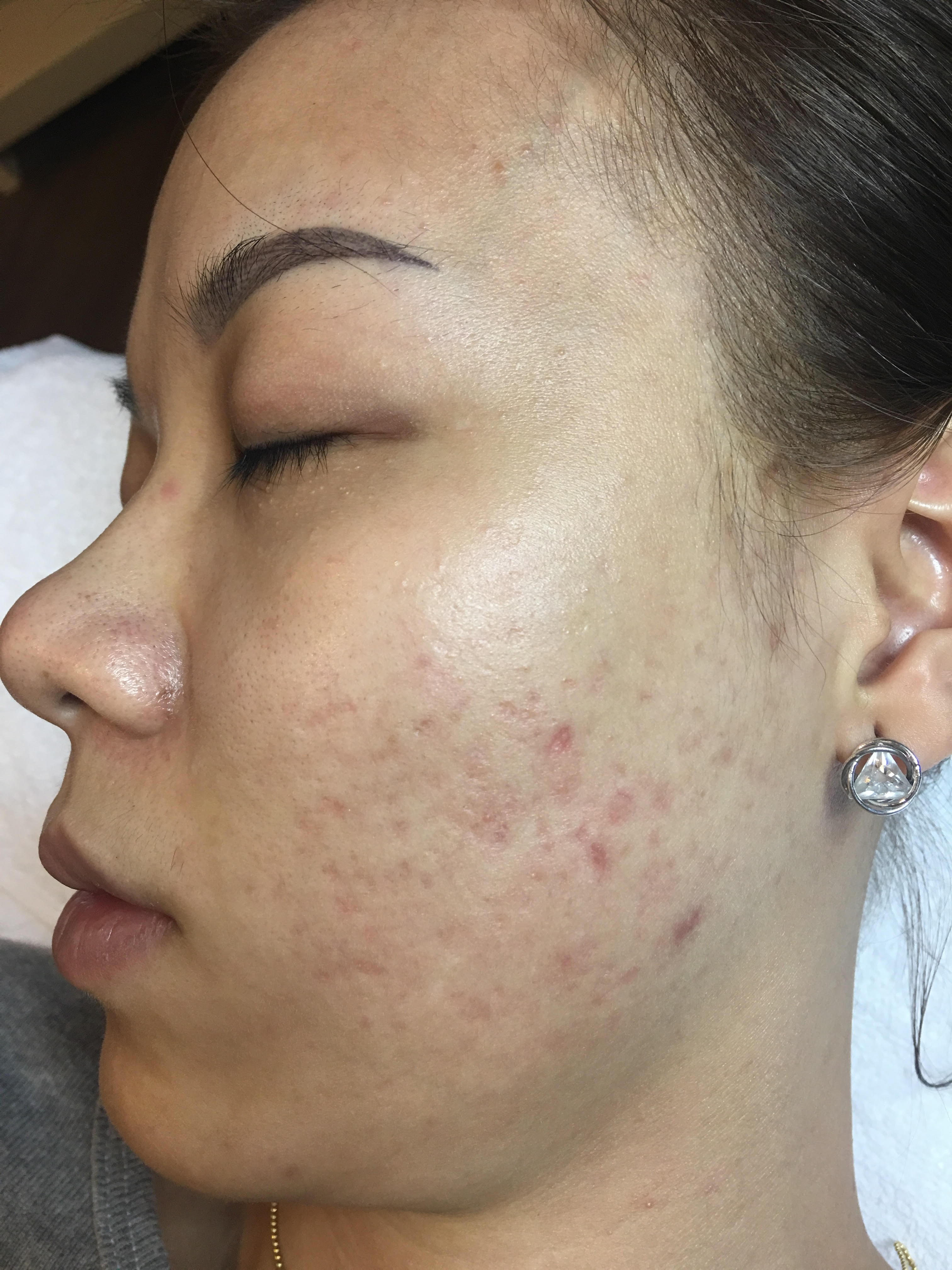 phuong phap tai tao da Ultranano tao song anh 4