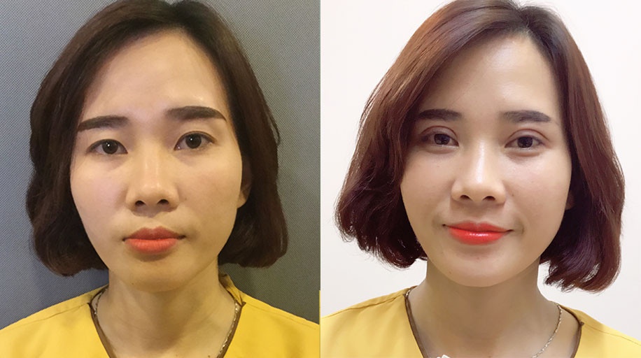 Uu diem cua phuong phap cat mi mat Mani Mini Deep 5D hinh anh