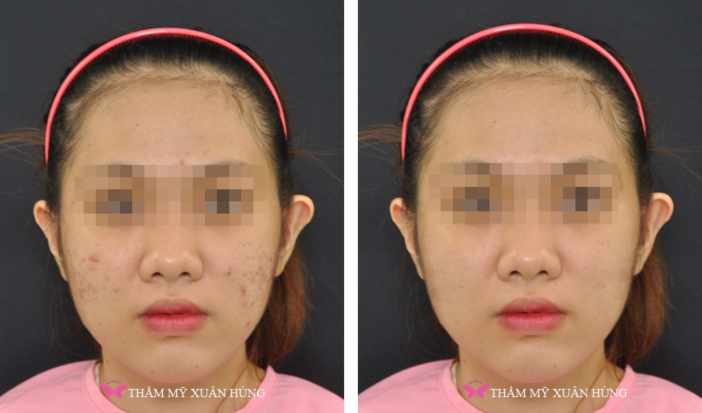 Trung tâm thẩm mỹ Xuân Hùng ảnh 5 Trung tam tham my Xuan Hung anh 5