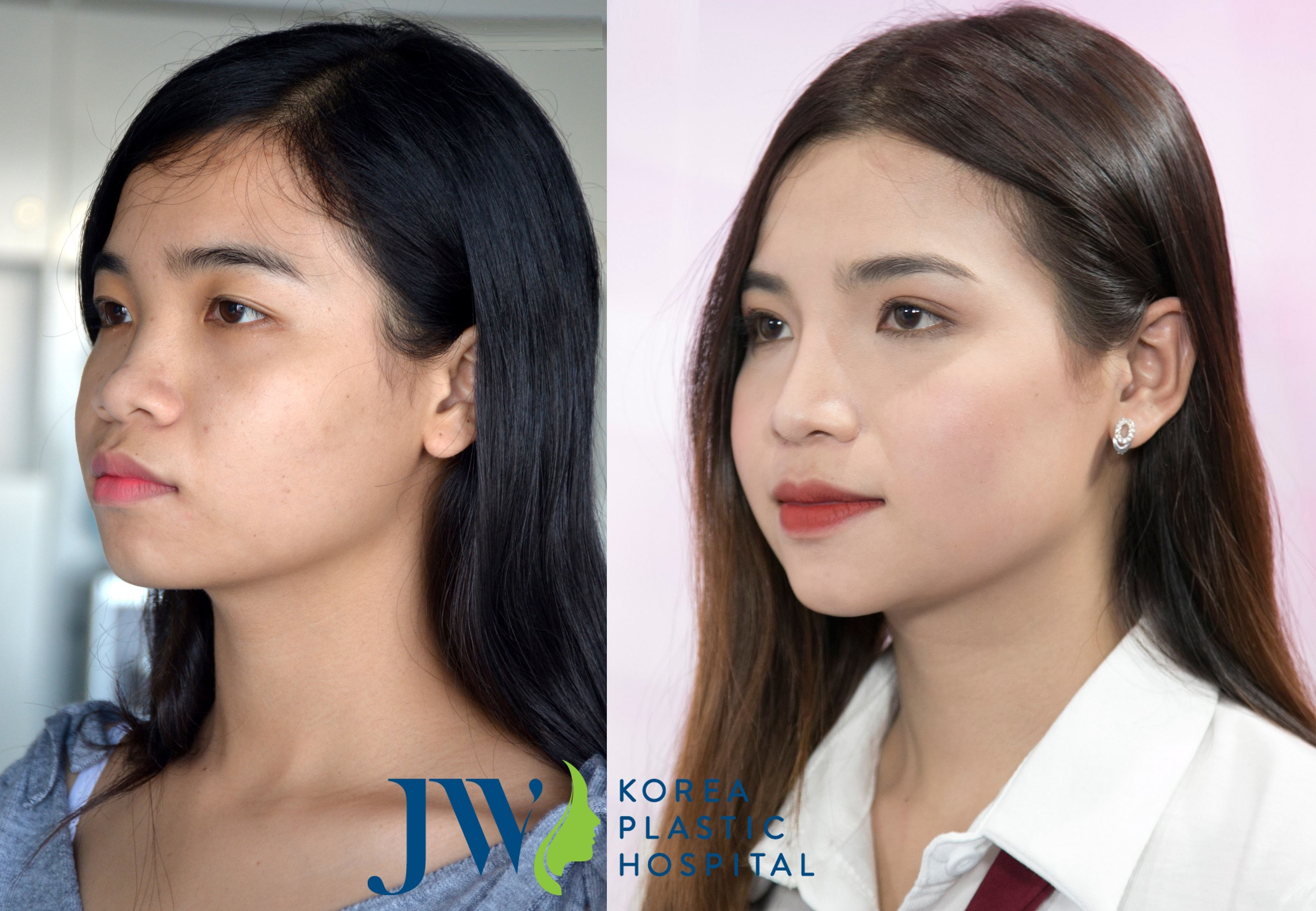 Bệnh viện Thẩm mỹ JW ảnh 4 Benh vien Tham my JW anh 4
