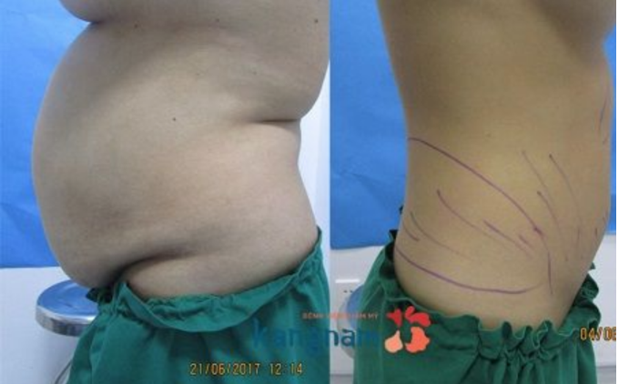 Benh vien tham my Kangnam anh 3