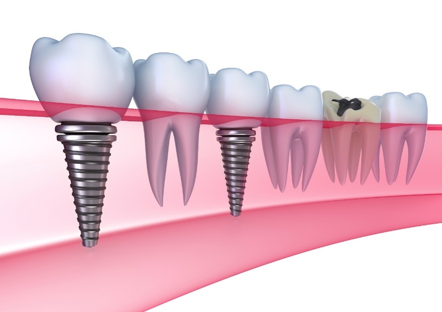 cắm ghép Implant ảnh 1 cam ghep Implant anh 1
