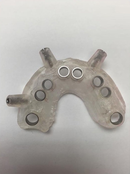 cắm ghép Implant ảnh 2 cam ghep Implant anh 2