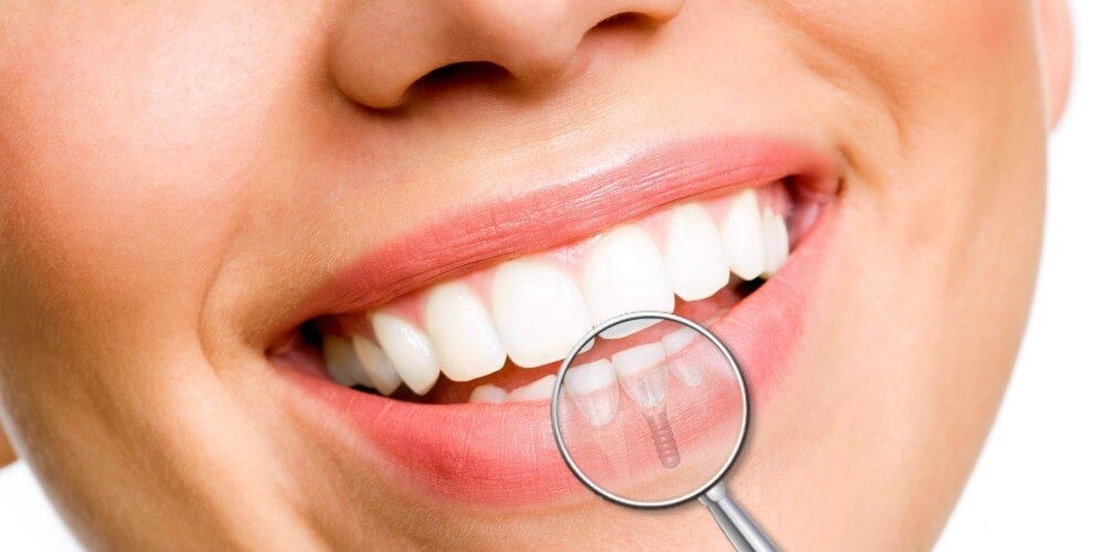 Bac si nha khoa giai dap thac mac ve trong rang Implant hinh anh