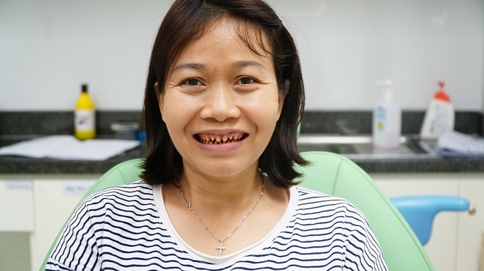 Phuc hinh cho rang boc su bi mai sai cach hinh anh