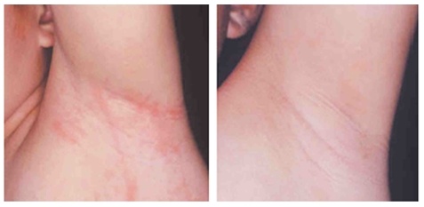 Atopalm ảnh 4 Atopalm anh 4