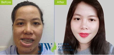 phẫu thuật chỉnh hàm,  JW ảnh 2 phau thuat chinh ham,  JW anh 2