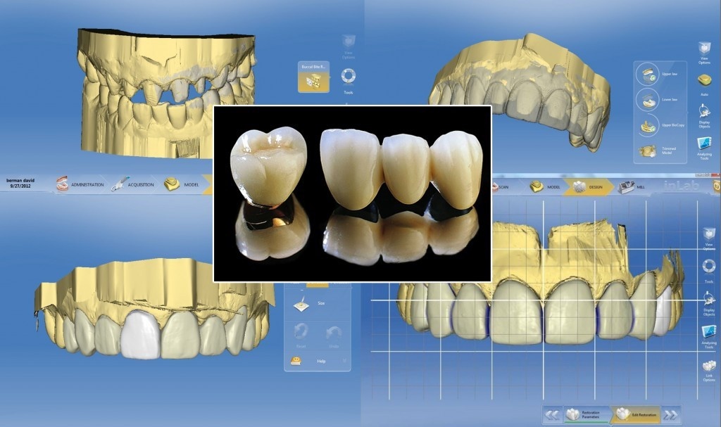 Nhung dieu can biet ve quy trinh mai rang khi trong rang su hinh anh