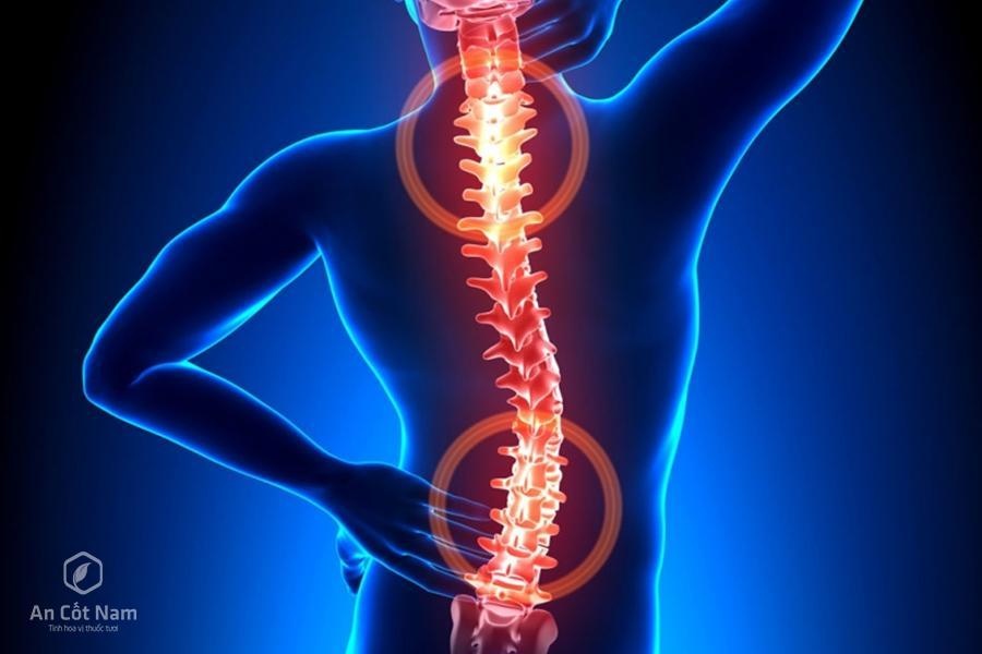 nguyên nhân thoát vị đĩa đệm ảnh 1 nguyen nhan thoat vi dia dem anh 1