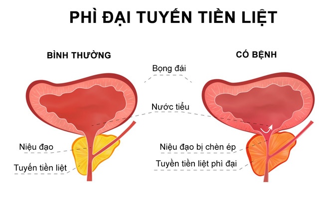 tiền liệt tuyến ảnh 2 tien liet tuyen anh 2