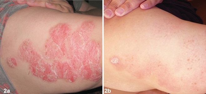 Dr. Michaels Psoriasis & Skin Clinic ảnh 1 Dr. Michaels Psoriasis & Skin Clinic anh 1