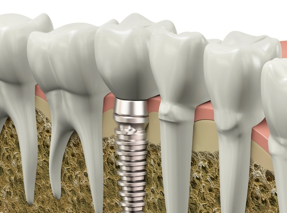 Trong rang gia co dinh bang phuong phap cay ghep Implant hinh anh