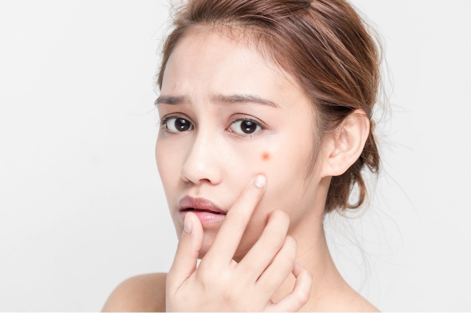 Bac si O2 Skin huong dan phuc hoi da mun sau Tet hinh anh