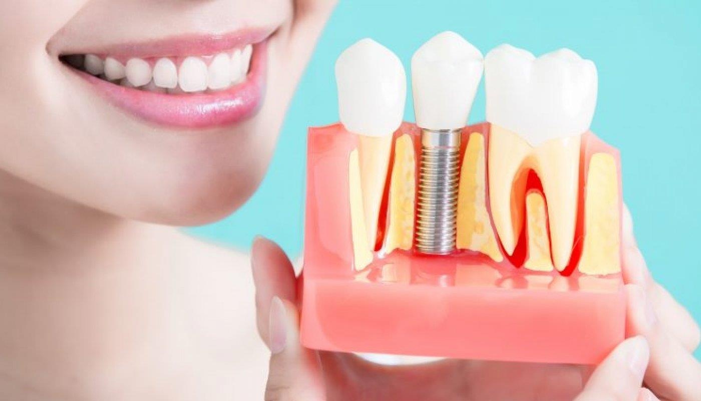 Tham khao chi phi dich vu cay rang Implant tai Nha khoa Dong Nam hinh anh