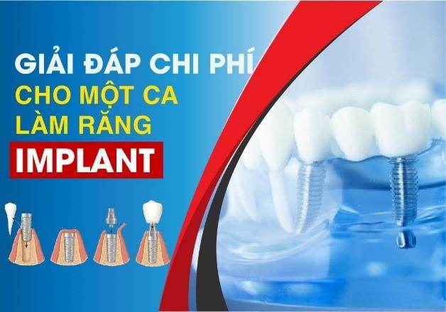 Tim hieu chi phi mot ca lam rang Implant hinh anh