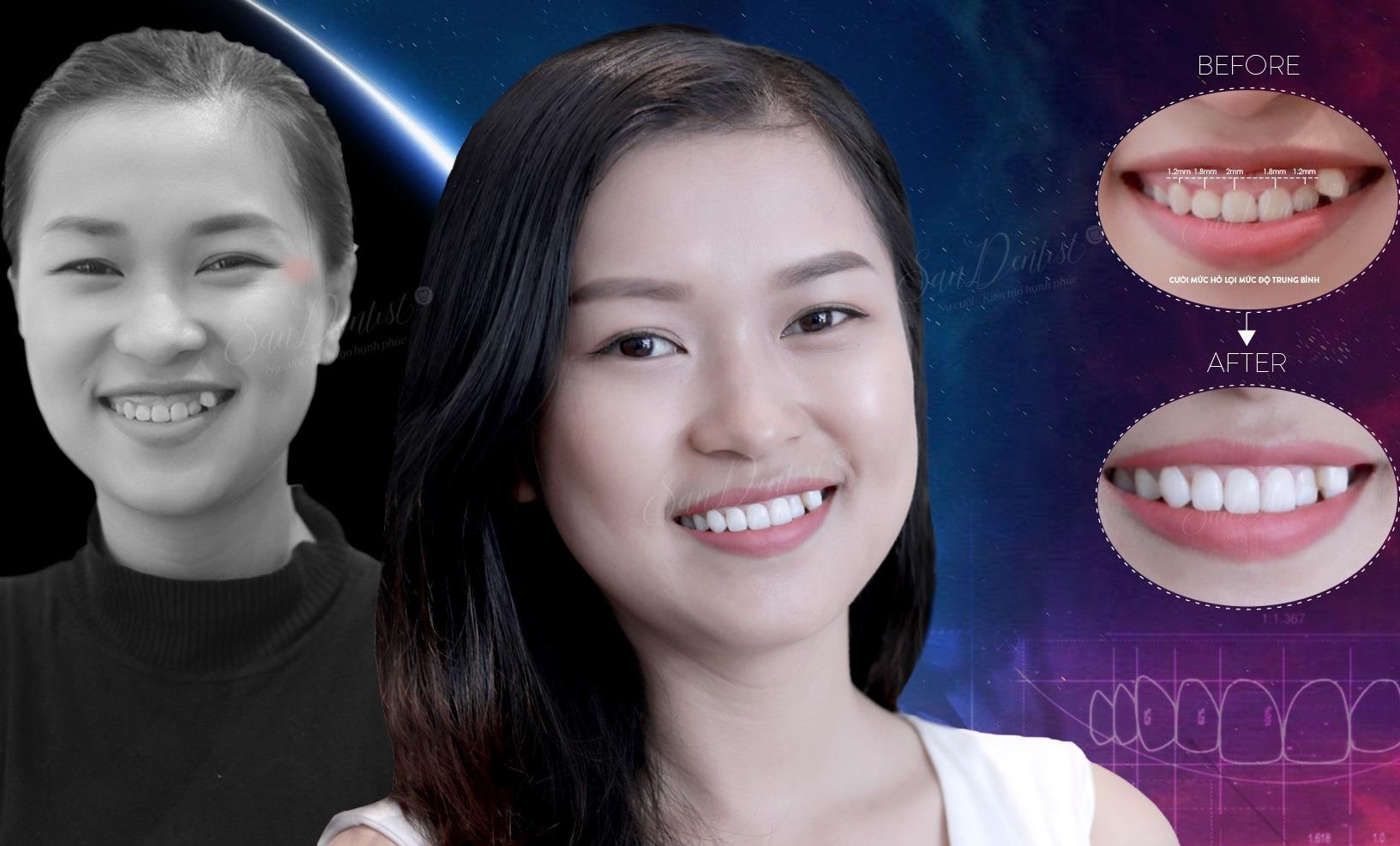 San Dentist gioi thieu phuong phap dieu tri ho loi chi voi 5 buoc hinh anh