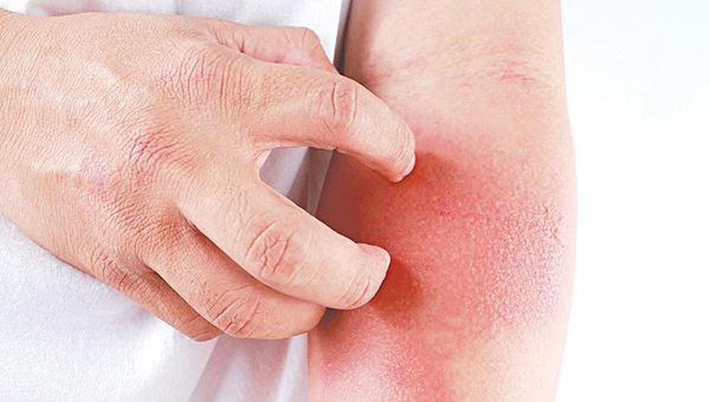 Giai phap dieu tri viem da co dia an toan tu tien si nuoc ngoai hinh anh