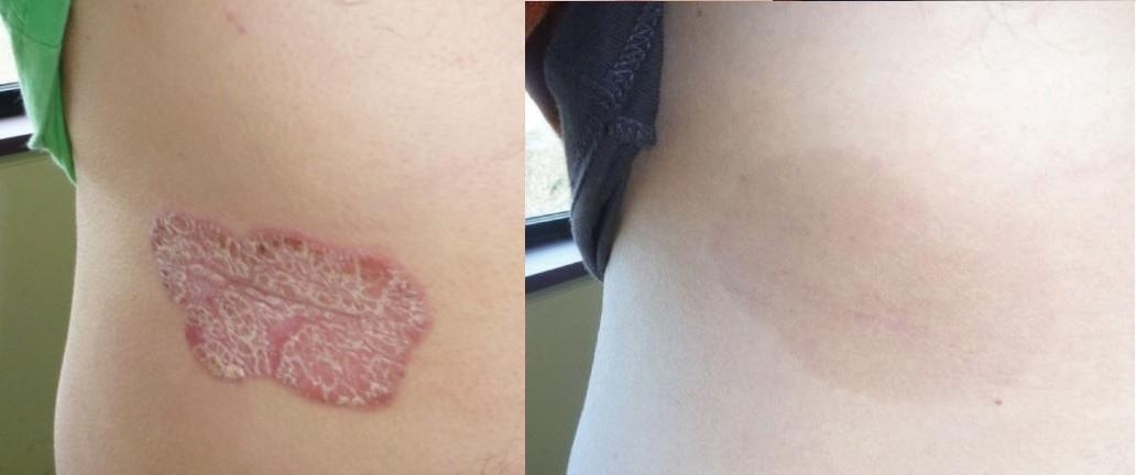 Phuong phap Dr. Michaels anh 1