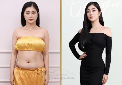 Smart Lipo  ảnh 4 Smart Lipo anh 4