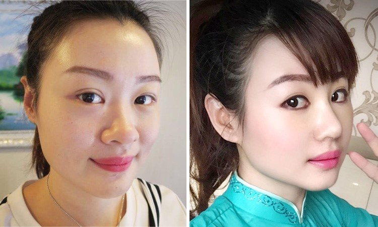 phẫu thuật ảnh 1 phau thuat anh 1