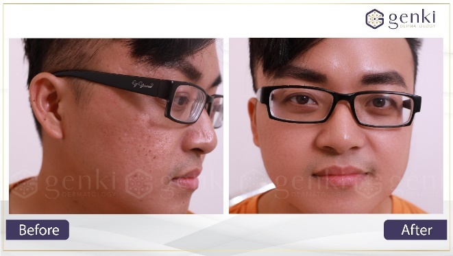 Genki Derma anh 4