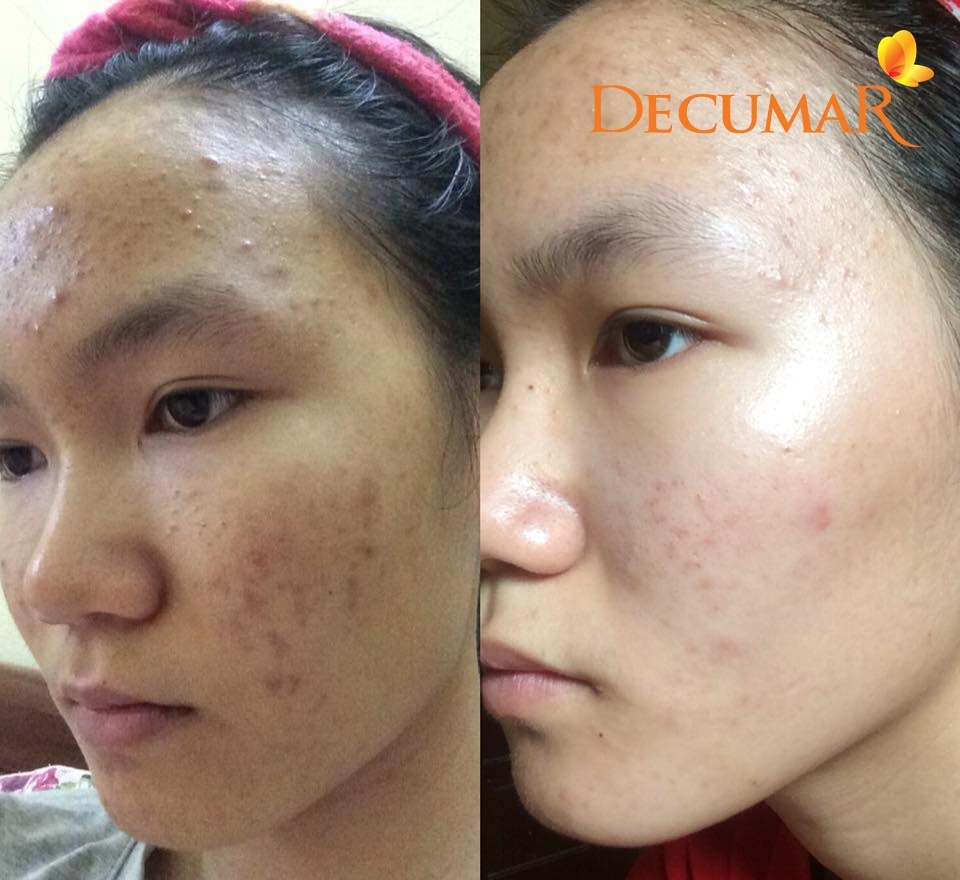 Decumar ảnh 2 Decumar anh 2