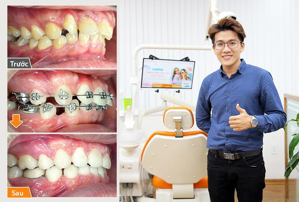 niềng răng tại Up Dental ảnh 1 nieng rang tai Up Dental anh 1